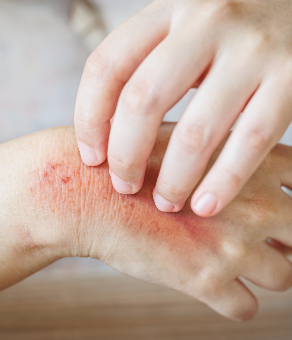 Fungal Infection Treatment at Fortitude Dermatology Delhi
