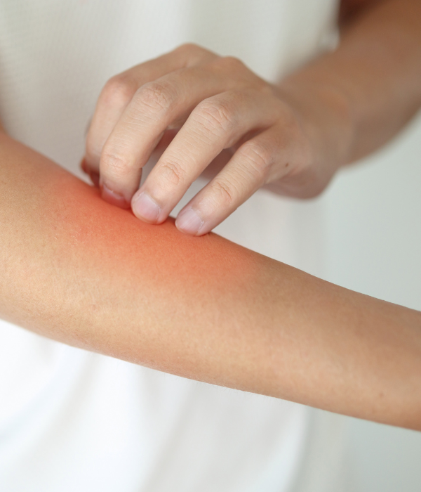 Eczema Treatment at Fortitude Dermatology Delhi
