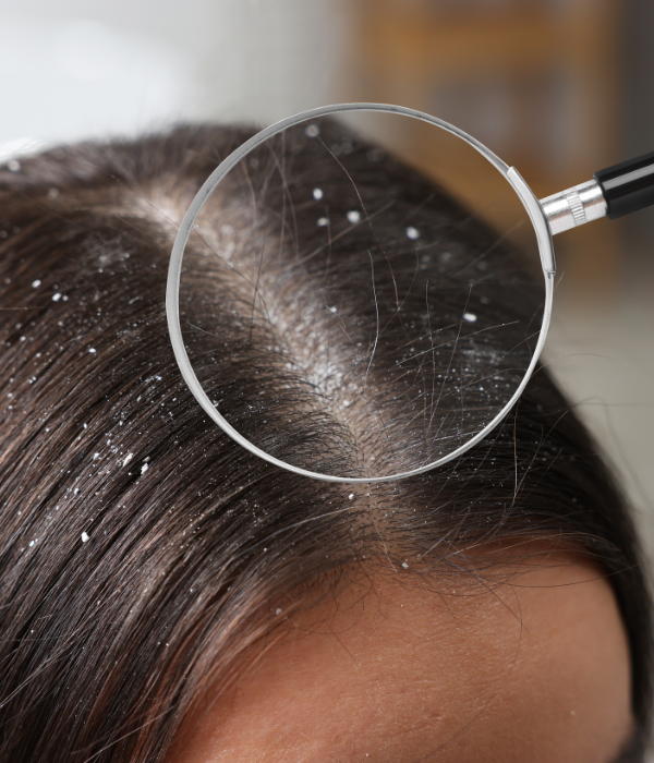 Advanced Dandruff Treatment