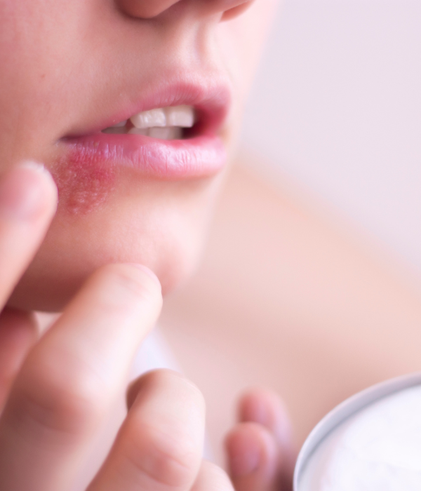 Viral Infection Herpes Treatment