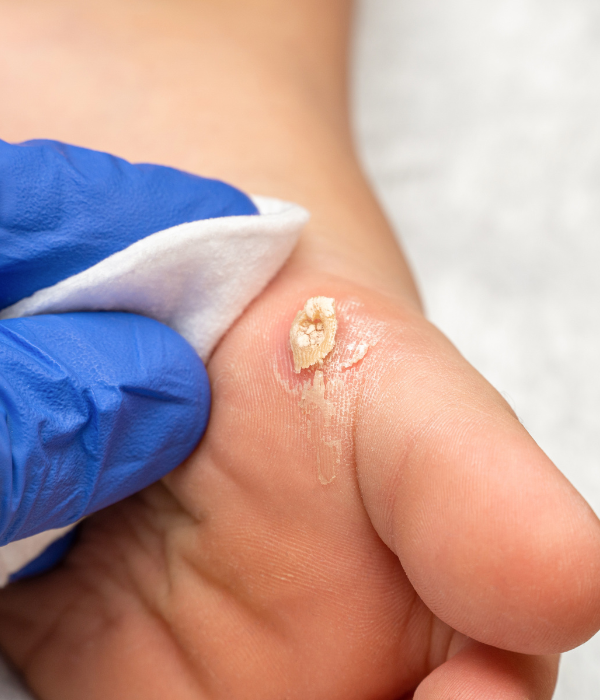 Warts Corns Treatment