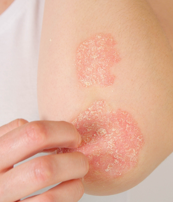 Psoriasis Treatment