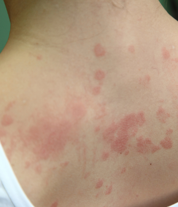 Urticaria Treatment