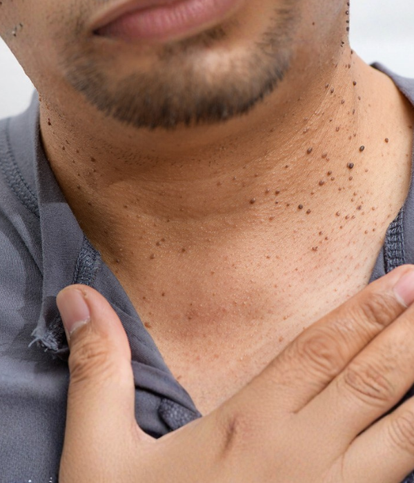 Skin Tags Treatment