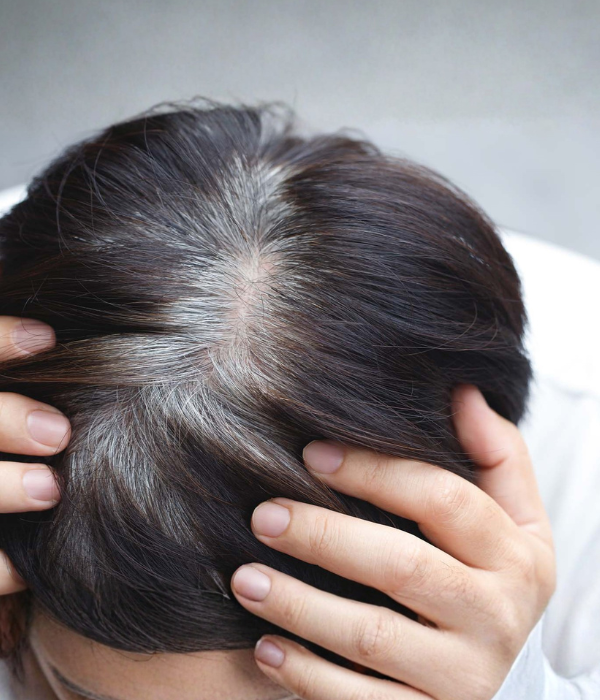 Greying of Hair Treatment at Fortitude Dermatology Delhi